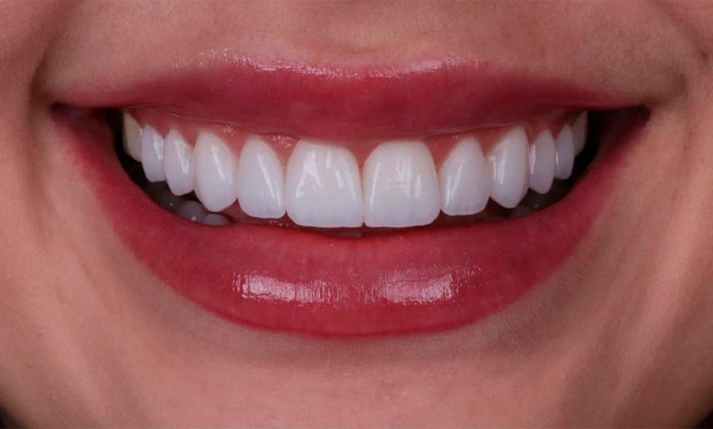 Lentes Dentárias