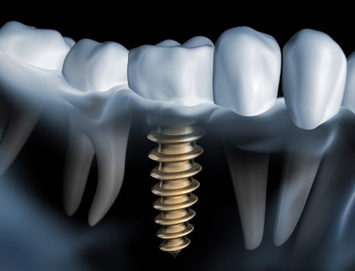 Implantes Dentários
